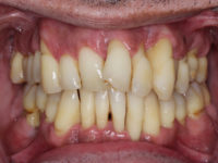 Περιοδοντίτιδα