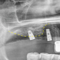 anipsosi_stage_3-700x460 squared